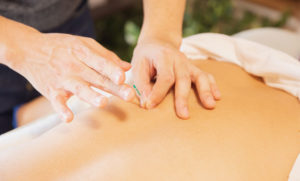 Acupuncture Therapy for Addiction Treatment