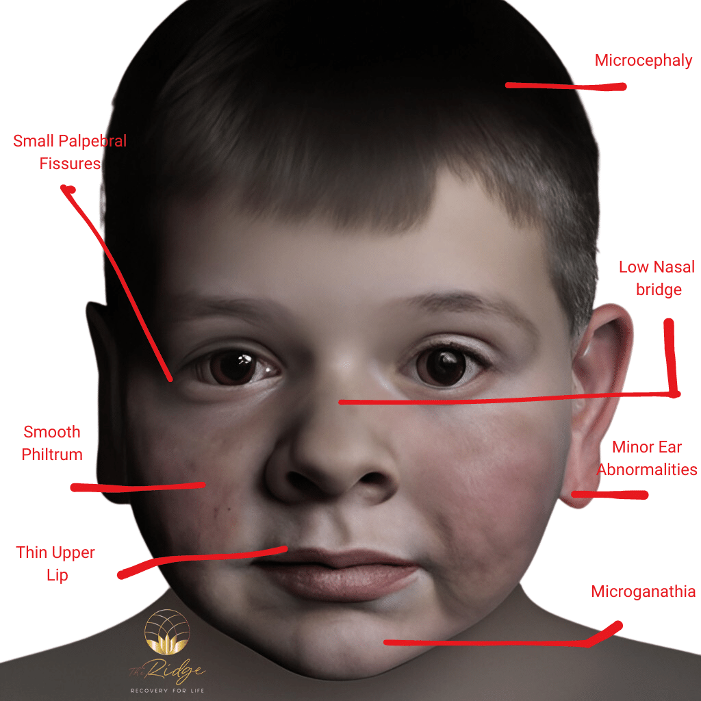 A Picture Of a Child with Fetal Alcohol Syndrome (FAS) (FASD)