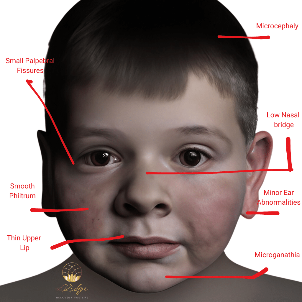 Fetal Alcohol Syndrome Symptoms